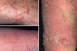 Bác sĩ da liễu khuyến cáo cách phòng tránh, điều trị viêm da do nọc độc kiến ba khoang