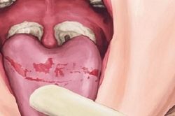 Hướng dẫn chẩn đoán và điều trị bệnh bạch hầu
