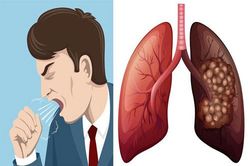 Dấu hiệu nào giúp nhận biết sớm ung thư phổi?
