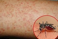 Bộ Y tế khuyến cáo phòng chống sốt xuất huyết