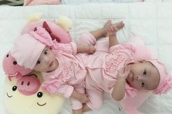 Gần 100 y bác sỹ sẽ tiến hành phẫu thuật tác đôi hai bé song sinh