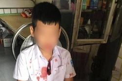 Nhà trường lên tiếng vụ bé trai bị phụ huynh của bạn đánh chấn thương, chảy máu khắp mặt