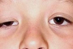 FDA phê chuẩn upneeq để điều trị sụp mí mắt ở người trưởng thành