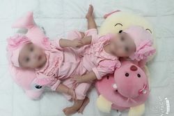 Thực hiện mổ tách cặp song sinh dính phức tạp