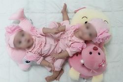 Đang mổ tách đôi cặp song sinh dính nhau hiếm gặp ở TP.HCM