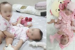 Hành trình chào đời của 2 bé song sinh dính liền nhau