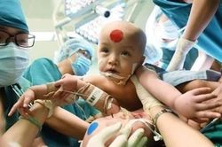 Dân mạng cầu chúc ca phẫu thuật tách rời cặp song sinh dính liền thành công