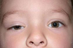 Xử trí khi bé bị sụp mi