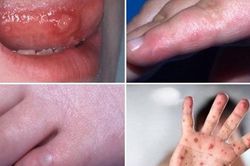 Cảnh báo: Trẻ nhập viện do mắc tay-chân-miệng gia tăng