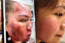 Bôi thuốc trị nám mua online, người phục nữ 'cháy đen' da mặt