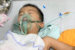 Bé trai 4 tuổi bị trâu húc thủng màng phổi