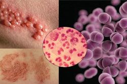 Ảnh hưởng của bệnh lậu đến sức khỏe nam giới