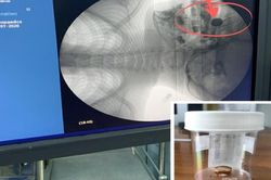 Cách xử trí đúng với dị vật trong mũi ở trẻ em