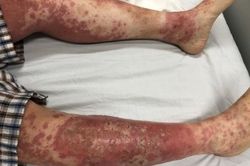 Hậu quả khó lường vì tự điều trị bệnh vảy nến