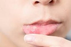 Ban miệng có thể cảnh báo mắc COVID-19