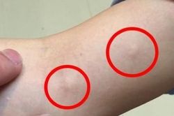 Bác sĩ ấn nhẹ đã thấy tay cô gái nổi nhiều u nang, bạn trai khiếp sợ hỏi có thể kết hôn không, bác sĩ giải đáp thế này