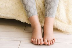 Phù do nắng nóng: Nguyên nhân, điều trị và cách phòng tránh
