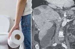 Bà cụ vào phòng cấp cứu vì phân chuyển sang màu bạc