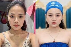 Công nghệ Tái sinh đa tầng duy trì được bao lâu?