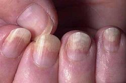 Nếu thấy móng tay có biểu hiện này cảnh báo cơ thể đang gặp bệnh, hãy đi kiểm tra sức khỏe ngay