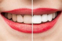 5 mẹo đánh bay vết ố vàng trên răng, hiệu quả không kém gì tẩy trắng