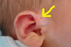 Thấy lỗ nhỏ ở vành tai kiểu này, đến gặp bác sĩ ngay vì căn bệnh nguy hiểm đang đứng ngay bên cạnh