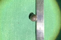 Cứu sống bệnh nhân bị đạn bi găm vào cột sống cổ