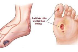 Tăng nguy cơ cắt cụt chi ở bệnh nhân tiểu đường trong đại dịch COVID-19
