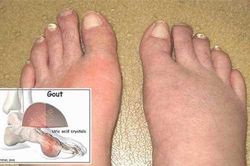 Dấu hiệu của bệnh gout