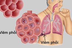 Gặp 6 dấu hiệu này hãy nghĩ ngay tới phổi đang hư hỏng nặng, hãy nhanh chân đi gặp bác sĩ ngay còn kịp