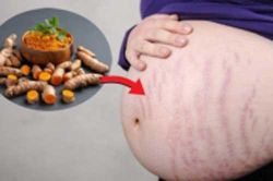 Cách trị rạn da bằng nghệ vừa rẻ lại hiệu quả bất ngờ, mẹ bầu nên thử ngay
