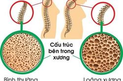 Thiếu hụt canxi và bổ sung thế nào cho đúng?