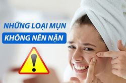 Các loại mụn không nên tự nặn và tuyệt đối không được nặn