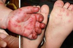 Nhận biết dấu hiệu nặng của bệnh tay-chân-miệng