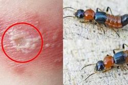 Phòng và xử trí khi bị kiến ba khoang đốt
