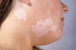 Thay đổi màu da - cảnh giác với bệnh bạch biến