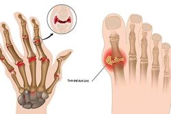 Gout căn bệnh của giới nhà giàu?