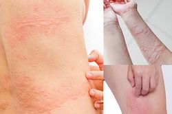 Bỏ túi 5 cách trị dị ứng mề đay do thay đổi thời tiết