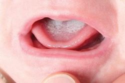 Chữa tưa lưỡi bằng thuốc cam, bé 3 tháng tuổi nguy kịch