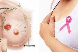 6 dấu hiệu cảnh báo sớm ung thư vú, chị em cần theo dõi thường xuyên hơn