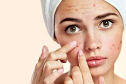 Giải pháp toàn diện đối phó với mụn trứng cá trong chu kỳ kinh nguyệt