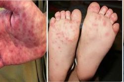 Dùng thuốc trong bệnh tay - chân - miệng ở trẻ