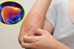 5 biểu hiện chứng tỏ gan đang rất 'nóng', cần thải độc càng sớm càng tốt