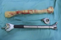 Lắp xương kim loại vào đùi bệnh nhân