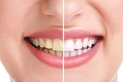 Răng ố vàng tới mấy cũng đổi màu sáng trắng ngay khi ngậm thìa nước này trước khi ngủ