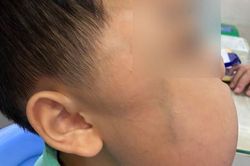 'Cắt' khối u xơ khổng lồ trên mặt bé trai 13 tuổi