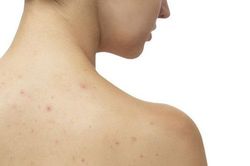 Đây là những cách bạn có thể khắc phục khi thấy lưng xuất hiện mụn