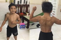 Cuộc sống của cậu bé 10 tuổi mắc hội chứng 'superman' hiếm gặp tại Việt Nam