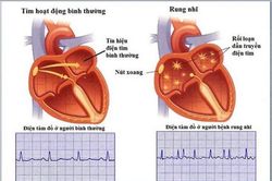 Đề phòng đột quỵ do rung nhĩ