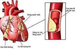 Những biểu hiện bệnh động mạch vành